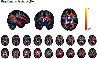 Impulsivity trait mediates the relationship between white matter integrity of prefrontal–striatal circuits and the severity of dependence in alcoholism